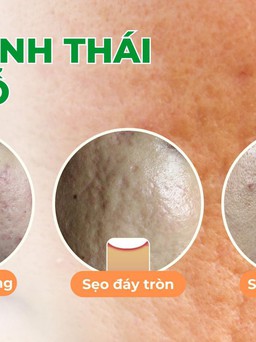 Sẹo rỗ và các phương pháp điều trị không phẫu thuật: Đường đến vẻ đẹp tự tin