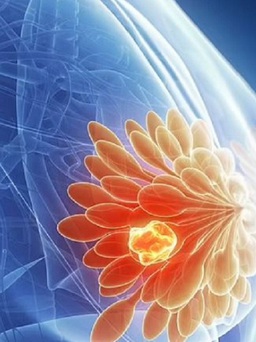 Phát hiện đột phá có thể ngăn ung thư vú tái phát đến hàng chục năm