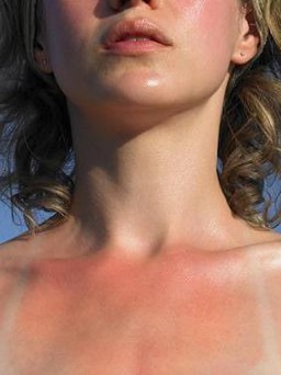 Góc giải đáp: Da bị cháy nắng phải làm sao? Cách làm dịu ngay tại nhà