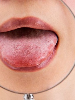 4 dấu hiệu thiếu vitamin D làm xuất hiện bất thường trên lưỡi