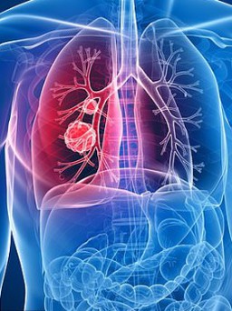 4 dấu hiệu ngay khi thức dậy cảnh báo bạn có thể mắc ung thư phổi