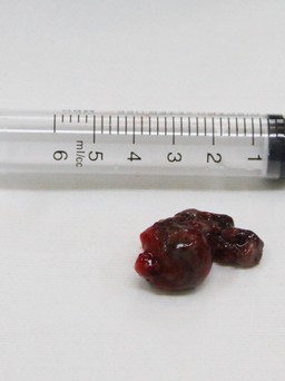 Phẫu thuật cắt khối u niệu đạo bị nhiễm trùng hoại tử
