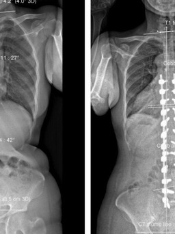 'Trả lại' 8cm chiều cao cho bệnh nhân sau ca mổ 7 tiếng đồng hồ