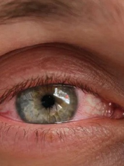 Đau mắt đỏ có thể tự khỏi không?