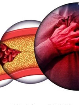 Phát hiện mới: Ăn chay có thể giúp giảm cholesterol