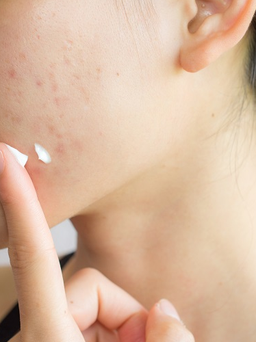 Salicylic Acid là gì? Công dụng và cách sử dụng hiệu quả ngăn ngừa kích ứng