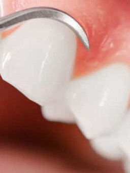 Chuyện lạ: Người phụ nữ nôn mửa nhiều đến mức rụng hết răng