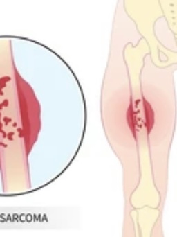 Nổi cục bằng hạt đậu ở đùi, vài tháng sau mất do ung thư di căn