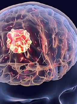 Bất ngờ đổi tính, đi khám mới biết mắc khối u não lớn bằng trái cam