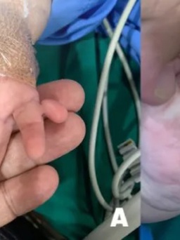 Phẫu thuật tạo hình cho bé gái có 24 ngón tay chân, bị dư ngón, dính ngón