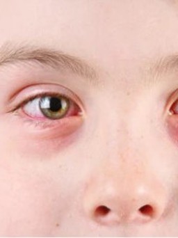 Đau mắt đỏ, khi nào cần đi bác sĩ khám?