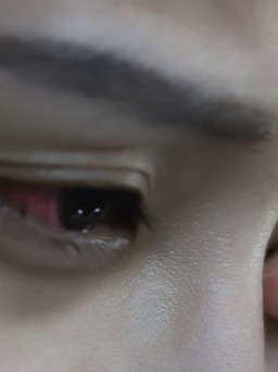 Tại sao khi bị đau mắt đỏ, mắt lại chuyển màu đỏ hoặc hồng?