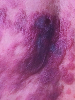 Biểu hiện bệnh da liễu có thể là di căn của ung thư