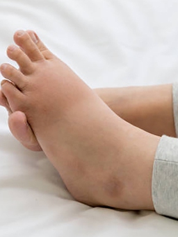 Dấu hiệu ít người biết ở chân khi ngủ dậy có thể cảnh báo bệnh tim