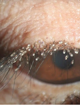 Nghệ An: Rận mu chi chít, đẻ trứng trên mi mắt nữ bệnh nhân