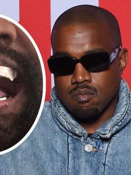 Kanye West gắn hàm răng giả hơn 20 tỉ đồng