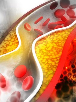 Ngày mới với tin tức sức khỏe: Có phải người ốm không bị cholesterol cao?