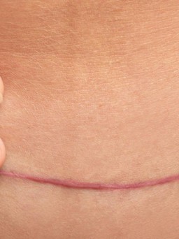 Sẹo phẫu thuật tạo thành bụng: Nguyên nhân và cách điều trị hiệu quả ngay tại nhà