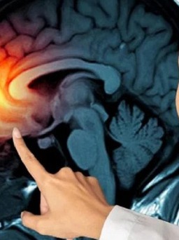 Ngày mới với tin tức sức khỏe: Phát hiện thuốc có thể ngăn ngừa ung thư não