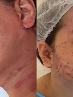 Nguyên nhân và cách khắc phục sẹo xấu trong phẫu thuật căng da mặt như thế nào?