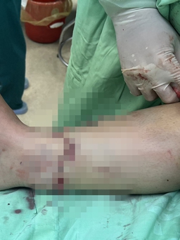Phẫu thuật 5 tiếng đồng hồ nối bàn chân bị đứt rời cho nữ bệnh nhân