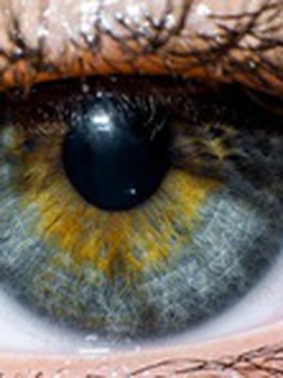 Công nghệ mới phẫu thuật tật khúc xạ giảm nguy cơ khô mắt sau mổ