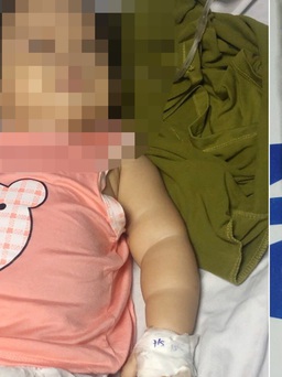 Bé gái 11 tháng tuổi ngộ độc nguy kịch do dùng ‘thuốc cam’ gia truyền