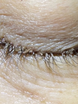Rận ký sinh, đẻ trứng trên mi mắt bệnh nhân