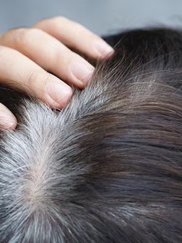 Tóc bạc sớm có liên quan đến bệnh?