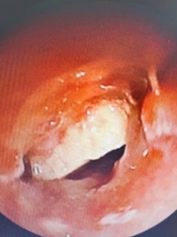 Nằm võng ăn bánh hạnh nhân, thiếu niên suýt mất mạng vì hóc dị vật