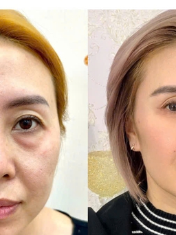 Xóa tan quầng thâm mắt bằng công nghệ Hydro Ultra Lift
