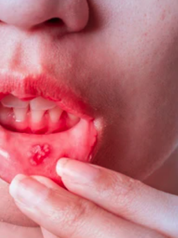 Bác sĩ chia sẻ cách phân biệt giữa nhiệt miệng và ung thư lưỡi