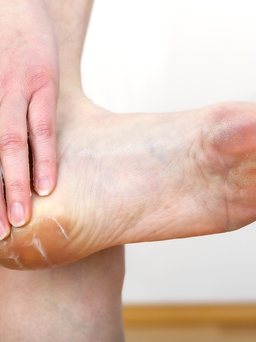 Những phương pháp tại gia chữa nứt gót chân