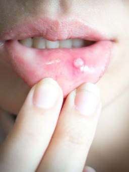 11 cách trị loét miệng tại nhà hiệu quả bạn cần biết