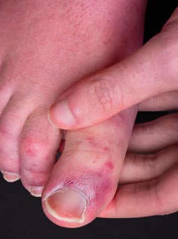 Hội chứng ‘ngón chân Covid’