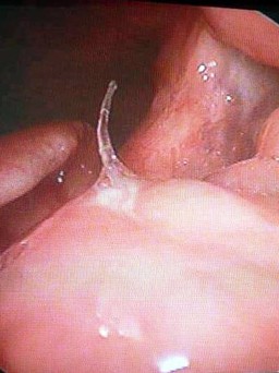 Gắp mảnh xương cá dài 2,5 cm cắm sâu dưới đáy lưỡi bệnh nhân ra