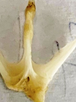 Quảng Nam: Gắp xương cá 4 chấu ra khỏi thực quản bệnh nhi 19 tháng tuổi