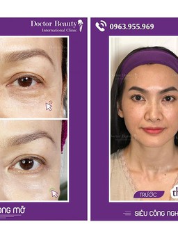 Doctor Beauty International Clinic tài trợ 50% Thermage FLX