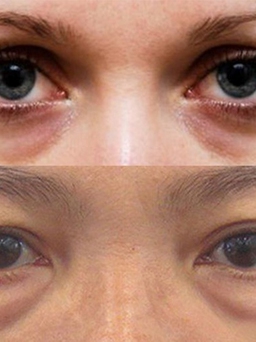 Phân biệt thầm quâng và bọng mắt giúp bạn tìm ra cách điều trị tốt nhất