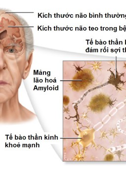 Hãy nhận biết sớm để điều trị hiệu quả bệnh mất trí nhớ Alzheimer