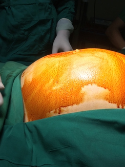 Phẫu thuật lấy khối u buồng trứng khổng lồ trong bụng cô gái