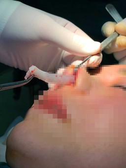 Bệnh nhân nâng mũi bị tai biến kể: 'phòng mổ' spa có chó chạy sủa lung tung
