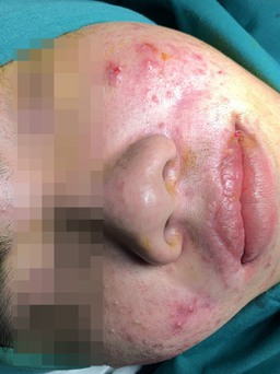 Chàng trai kể: Cả nhóm mua silicon ‘xách tay’ về tự tiêm để 'làm đẹp'