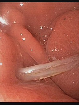 Bình Phước: Gắp ra xương cá dài 4 cm đâm sâu trong dạ dày bệnh nhân