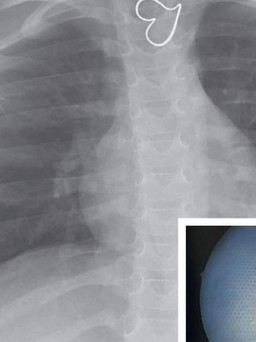 Phát hiện 'trái tim' trên hình X-quang của bé gái 3 tuổi