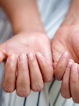 6 dấu hiệu 'tố cáo' bạn có thể bị thiếu chất sắt, chớ bỏ qua!
