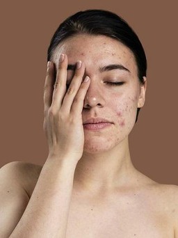 Bí quyết phục hồi làn da nhiễm corticoid hiệu quả chắc chắn bạn chưa biết