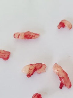 Quảng Ninh: Bác sĩ lấy ra 10 chiếc răng ngầm từ người bệnh có khối u xương hàm