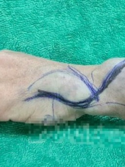 Phẫu thuật khối dị dạng mạch máu vùng cẳng, bàn tay cho người phụ nữ