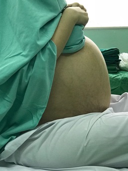 Cô gái mang khối u 18 kg, bụng to hơn bụng thai phụ